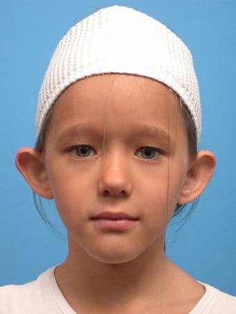 Otoplasty before 418922