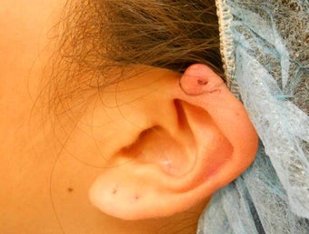 Keloid Removal before 513407