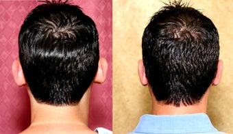 Otoplasty or ear push back surgery before 583653