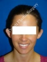 Ear Surgery (Otoplasty) 616652