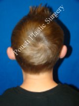 Ear Surgery (Otoplasty) before 616658