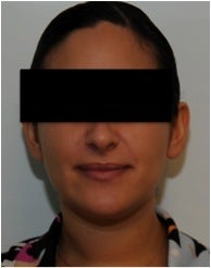 Evolence Injection Lips before 123634