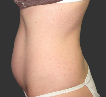 Exilis after 423763