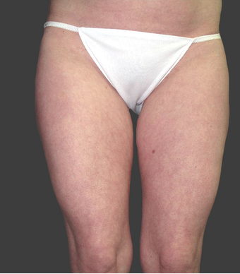 Exilis after 423770