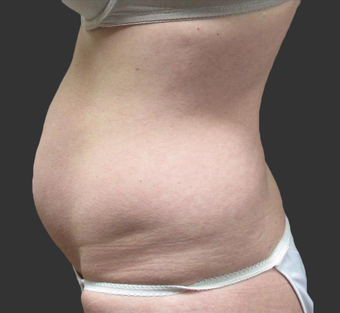 Exilis before 423763