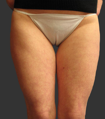 Exilis before 423770