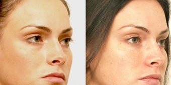 Non Surgical Liquid Eyelid Lift after 619696