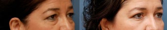 Lower Blepharoplasty before 314263