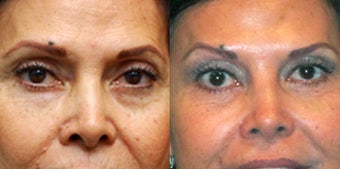 Non Surgical Liquid Eyelid Lift before 549878