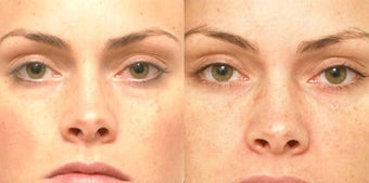 Non Surgical Liquid Eyelid Lift before 619696