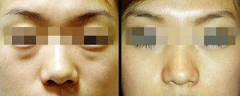 Lower Eyelid(Blepharoplasty) Surgery before 650673