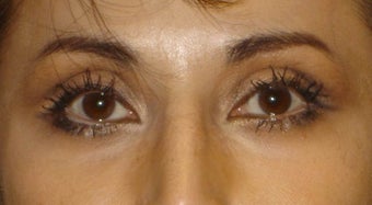 Upper Lid ptosis repair after 251674