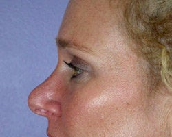Eyelid Surgery after 280385