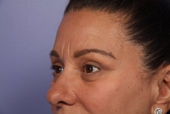Eyelid Surgery after 306427