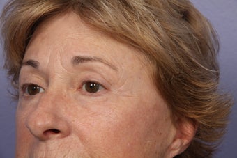 Eyelid Surgery after 306435