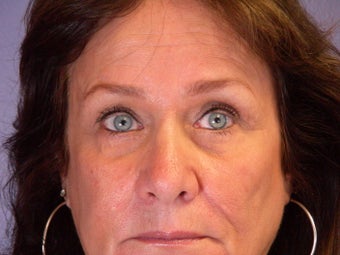 Eyelid Surgery after 306442