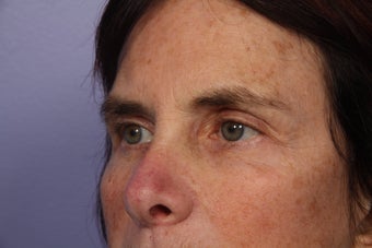 Eyelid Surgery after 306454