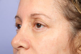 Eyelid Surgery after 306457