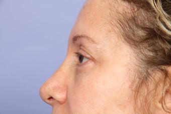Eyelid Surgery after 306458
