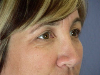 Eyelid Surgery after 306461