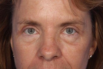 Eyelid Surgery after 324135