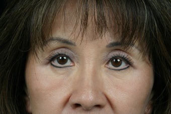 Eyelid Surgery after 324177