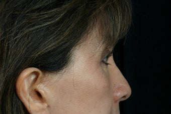 Eyelid Surgery after 324179