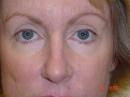 Eyelid Surgery (Blepharoplasty) after 341923