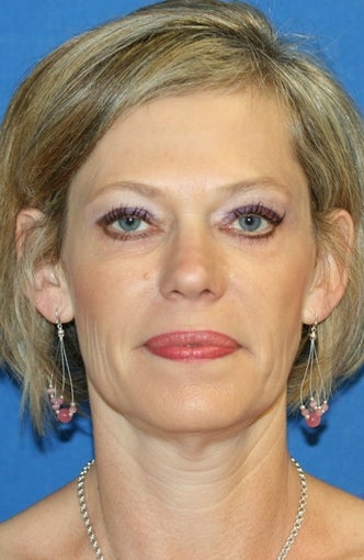 Eye Rejuvenation after 367605