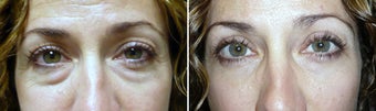 Cosmetic eyelid surgery before 127641