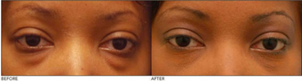Lower Eyelid Blepharoplasty before 138713