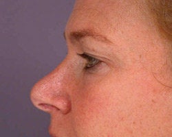 Eyelid Surgery before 280385