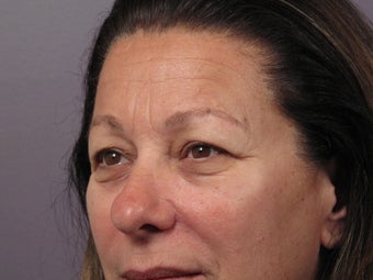 Eyelid Surgery before 306427