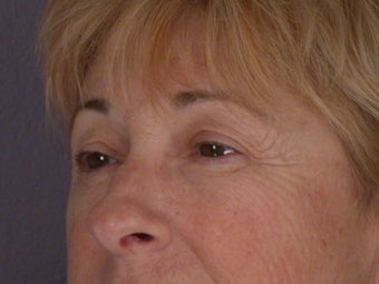 Eyelid Surgery before 306435