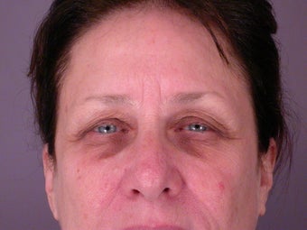 Eyelid Surgery before 306442