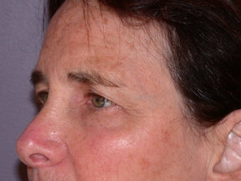 Eyelid Surgery before 306454