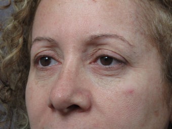 Eyelid Surgery before 306457