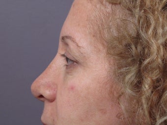 Eyelid Surgery before 306458