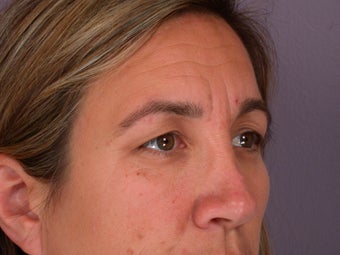 Eyelid Surgery before 306461