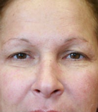 blepharoplasty before 309062