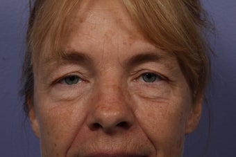 Eyelid Surgery before 324135