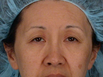 Eyelid Surgery before 324177