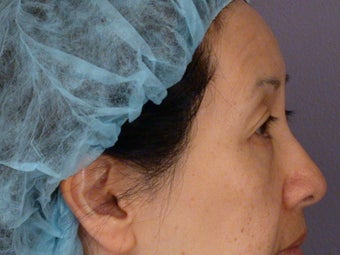Eyelid Surgery before 324179