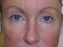 Eyelid Surgery (Blepharoplasty) before 341923