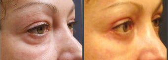 Upper & Lower eyelid surgery before 451813