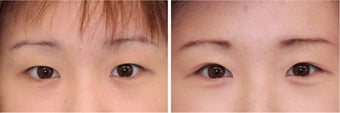 Double Eyelid Surgery - Suture Technique before 609875