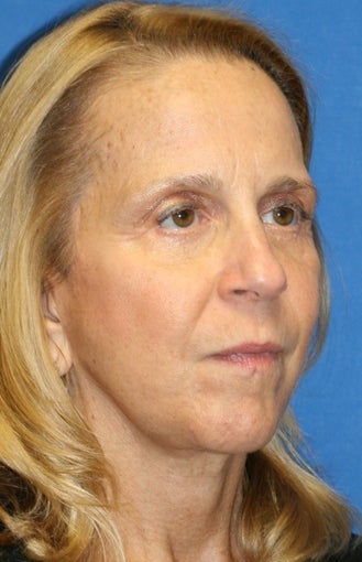 5 months post-op: Facelift, Necklift, Full Face Fat Transfer, and Lower Eyelid Skin Pinch after 385692