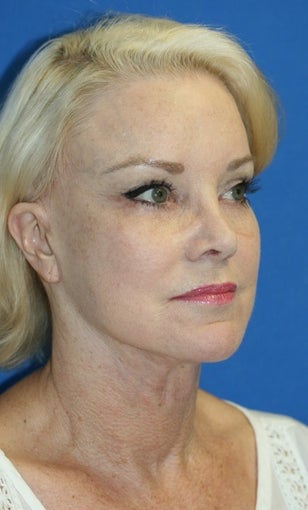 Facelift with Extended Necklift, Browlift, Peri-orbital Fat Transfer, and Skin Pinch after 574439