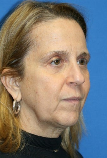 5 months post-op: Facelift, Necklift, Full Face Fat Transfer, and Lower Eyelid Skin Pinch before 385692