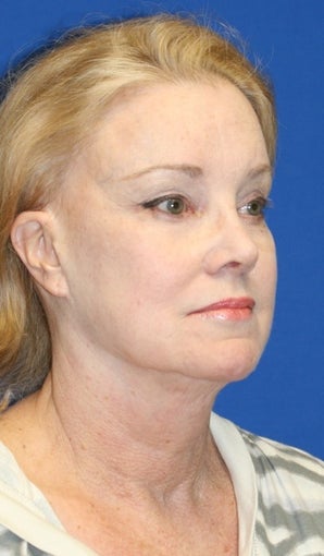 Facelift with Extended Necklift, Browlift, Peri-orbital Fat Transfer, and Skin Pinch before 574439